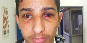 الاحتلال ينكّل بأسير من بيت لحم خلال اعتقاله