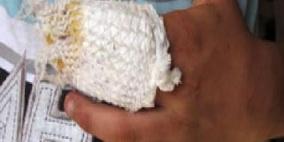 بتر أصبع شاب نتيجة عبثه بالألعاب النارية في الخليل