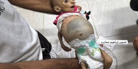 4 وفيات جراء التجويع في غزة خلال الـ24 ساعة الماضية