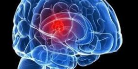 الذكاء والنجاح يجعلك أكثر عرضة لسرطان الدماغ!
