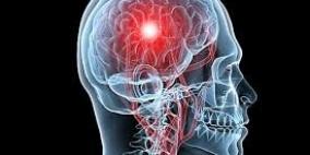 اكتشاف “السكتة الدماغية” قبل حدوثها بات حقيقة!