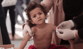 اليونيسف: 9 آلاف طفل دون 5 سنوات في غزة يعانون سوء تغذية حاد