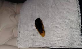 صور| مجمع ناصر الطبي بغزة يستخرج بذرة عباد شمس من حلق طفلة ويُنقذ حياتها