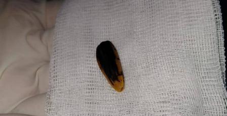 صور| مجمع ناصر الطبي بغزة يستخرج بذرة عباد شمس من حلق طفلة ويُنقذ حياتها