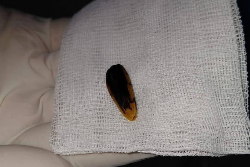 مجمع ناصر الطبي يستخرج بذرة عباد شمس من حلق طفلة ويُنقذ حياتها